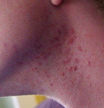 blemishes on Neck